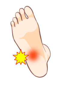 足底筋腱膜炎